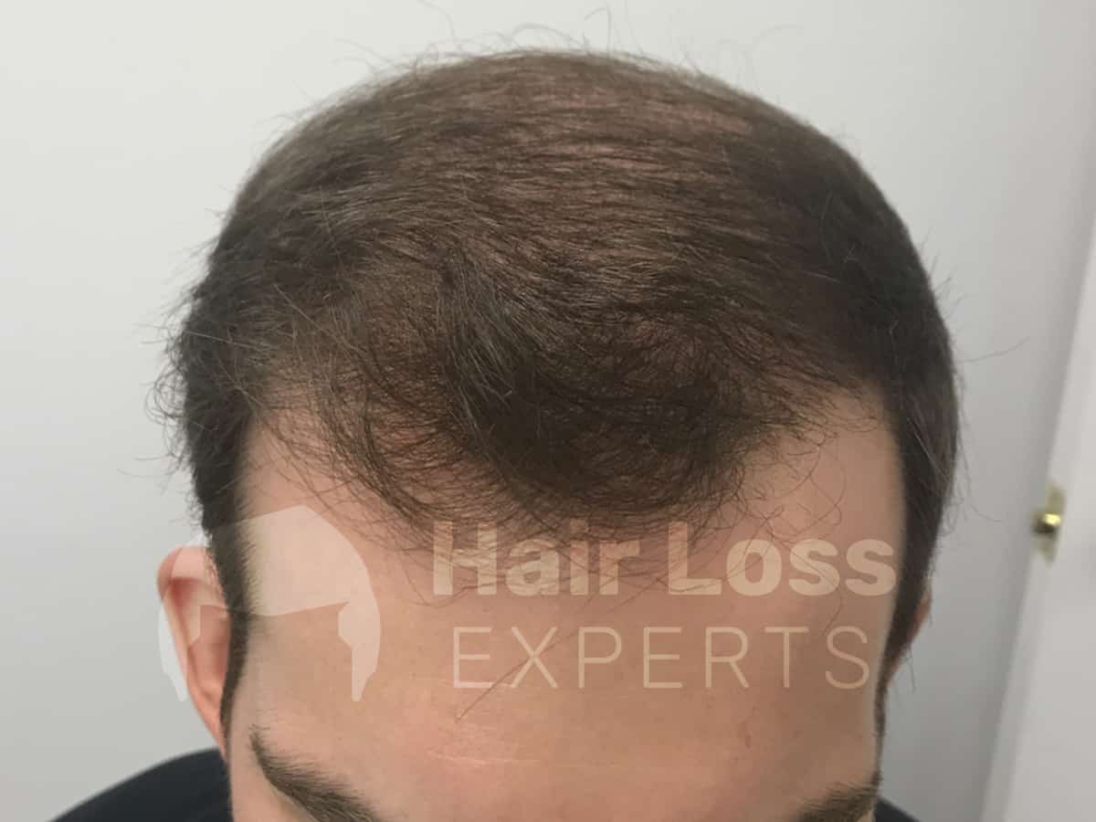 After: Nine month hair transplant result
