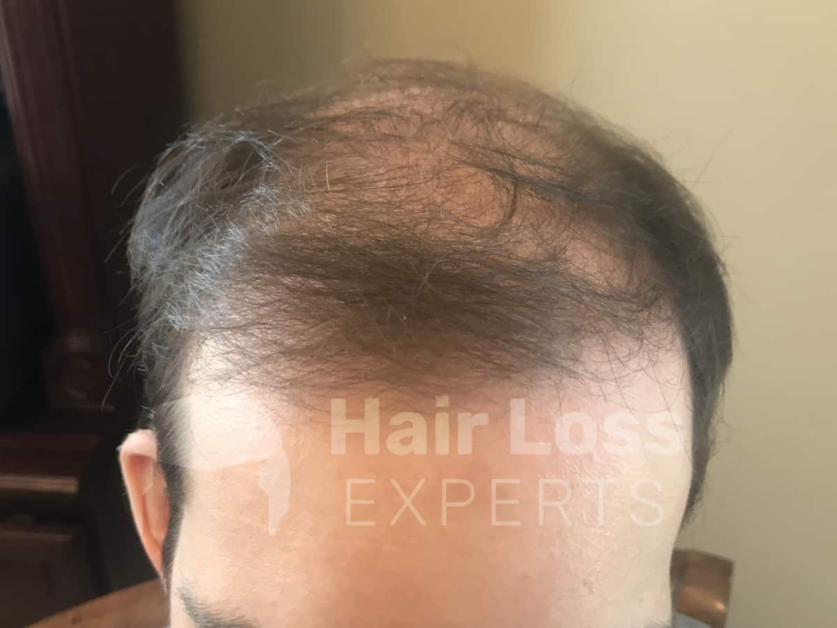 Before: Nine month hair transplant result